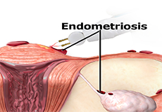 Excision of Endometriosis