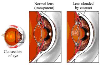 Cataracts (Phacoemulsification)