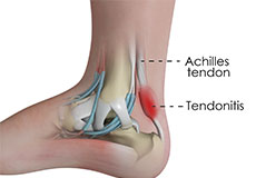 Achilles Tendonitis