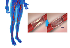 Angioplasties for Lower Limb Ischemia and Claudication
