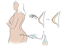 Autologous Fat Transfer for Breast Enlargement