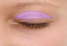 Blepharoplasty