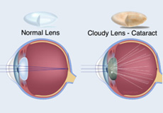 Cataract Surgery