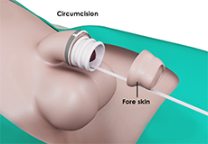 Circumcision