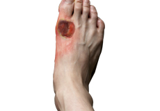 Diabetic Foot