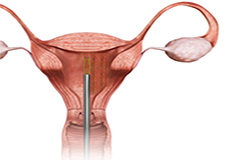 Endometrial Ablation