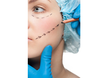 Facelift/Meloplasty