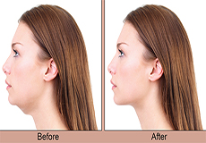 Chin Augmentation (Genioplasty)