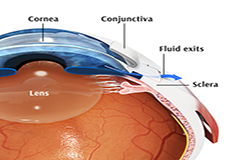 Glaucoma Treatment