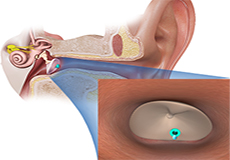 Tympanostomy Tube Placement