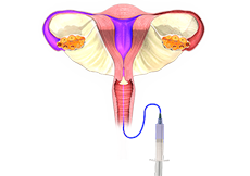 hysterosalpingography(HSG)