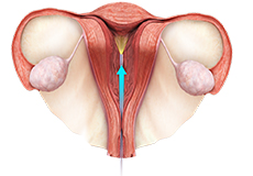 Hysteroscopy