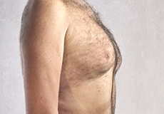 Male Breast Reduction (Gynecomastia)