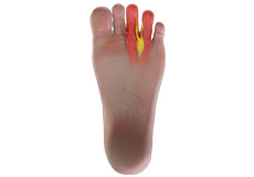 Neuroma