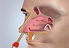 Nasal Cautery