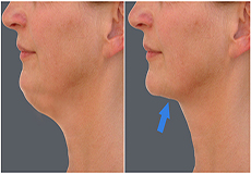 Neck Lift