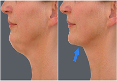 Neck Lift