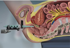 Prostate Biopsy