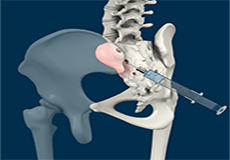 Sacroiliac and Peripheral Joint Injections