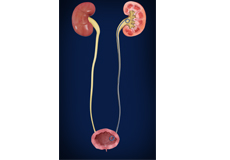 Stenting of Ureter