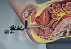 TRUS (Transrectal Ultrasound Guided Biopsy)