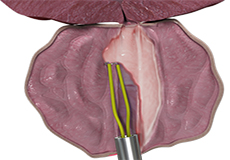 Transurethral Resection of the Prostate (TURP)