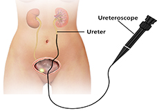 Urethro/Urteroscopy