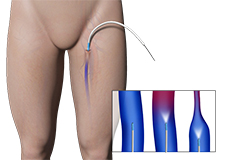 Varicose Vein Treatment